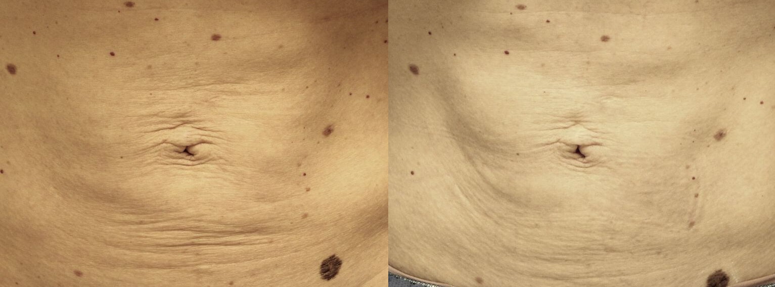 How to Tighten Skin After Weight Loss Naturally in 2025 | Effective & Proven Remedies | Imboxnews.com